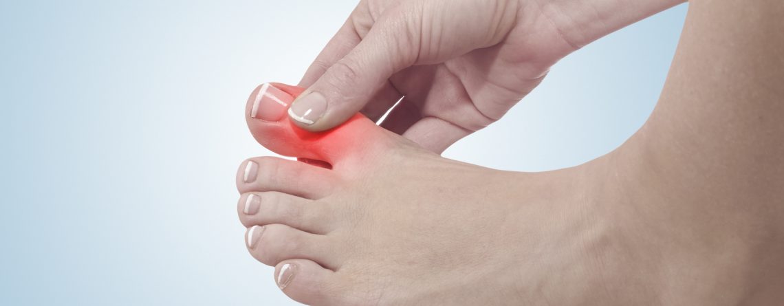 Artritis Gotosa: Eficacia y seguridad del tratamiento