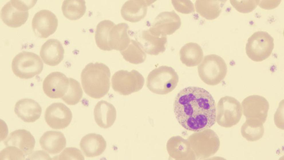 ¿Cómo abordar la Trombocitosis?