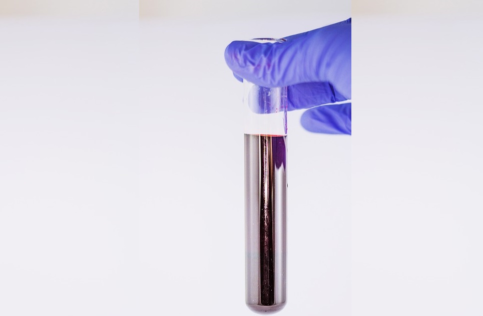 Hemoglobina Glicosilada Vs. Hemoglobina Glicada: ¿Cómo debe reportarse?